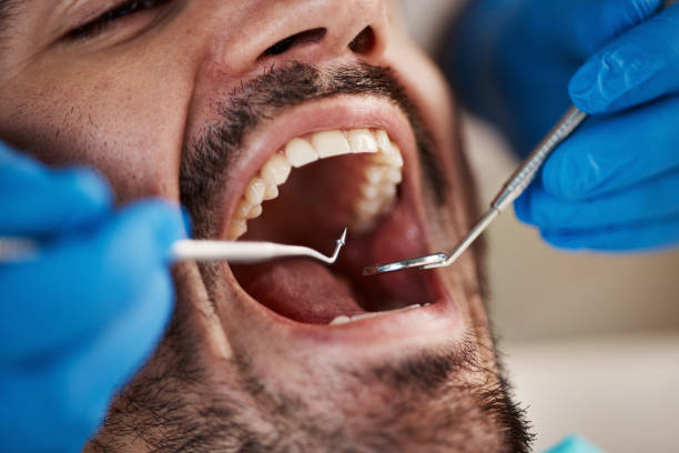 Best Urgent Care for Lost Fillings or Crowns in Terrace Heights, WA